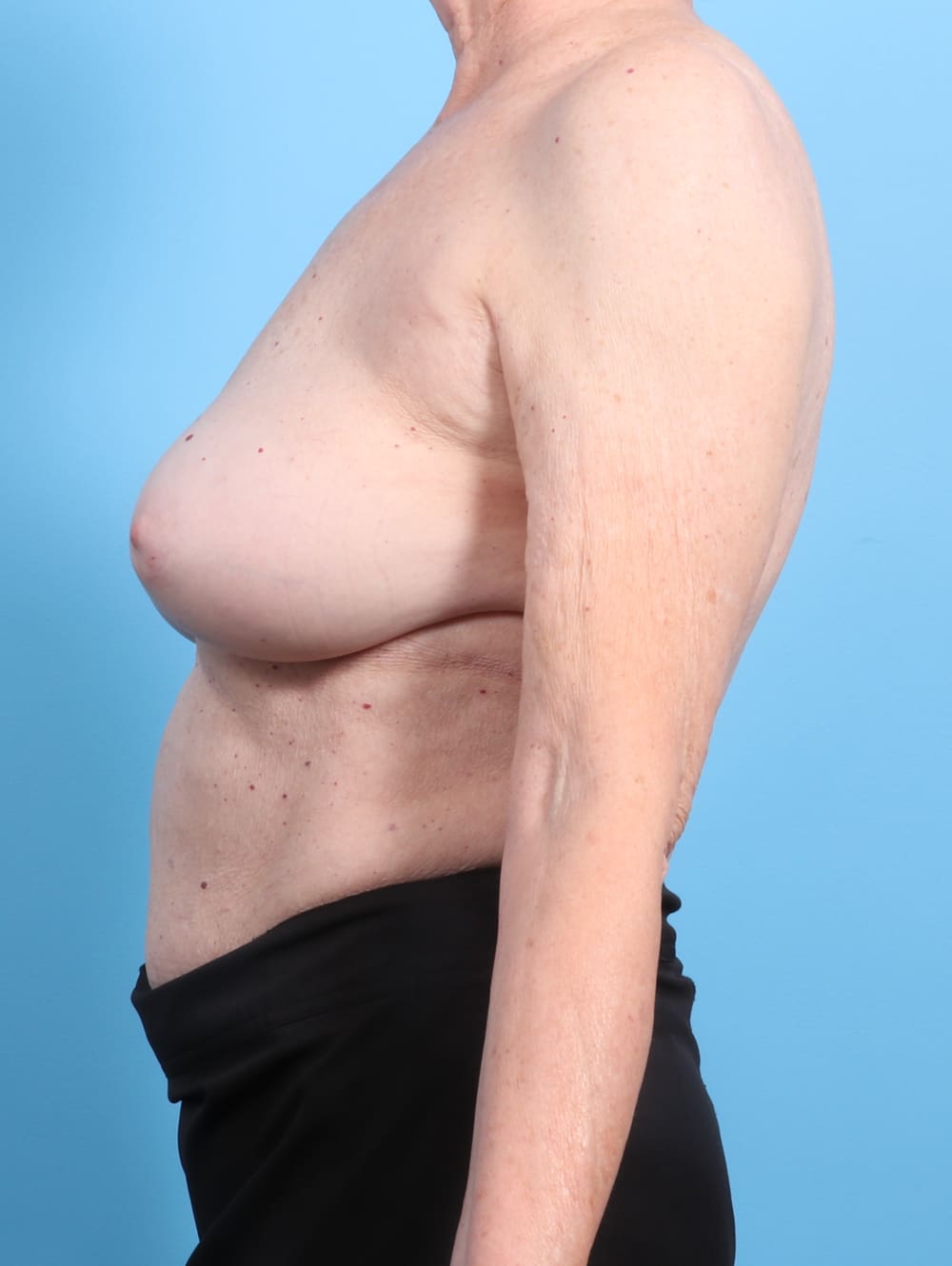 Breast Implant Revision Patient Photo - Case 2346 - after view-2