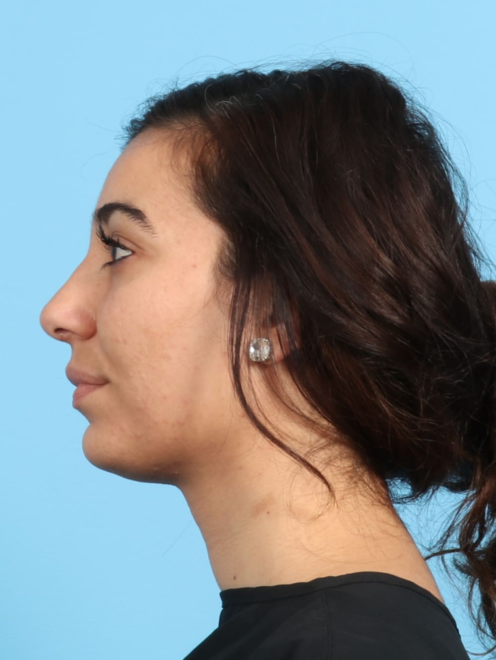 Rhinoplasty Patient Photo - Case 2354 - after view-0