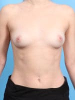 Breast Augmentation - Case 2428 - Before