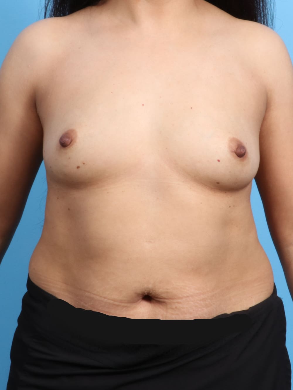 Breast Augmentation Patient Photo - Case 2436 - before view-