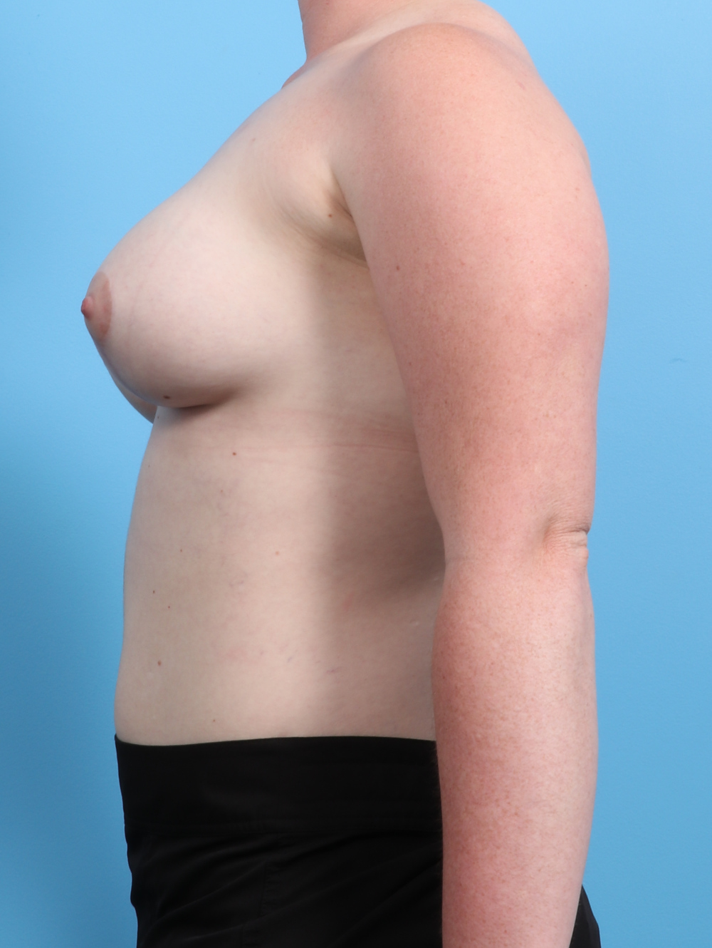 Breast Lift with Implants Patient Photo - Case 2452 - after view-2
