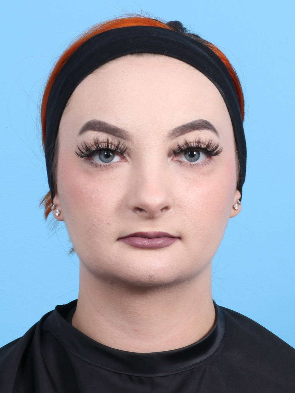 Rhinoplasty Patient Photo - Case 2528 - after view-1