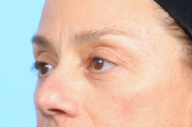Eyelid Surgery Patient Photo - Case 2544 - before view-1