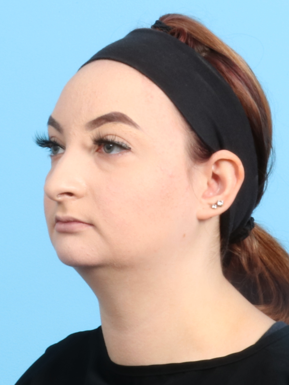 Rhinoplasty Patient Photo - Case 2528 - before view-2