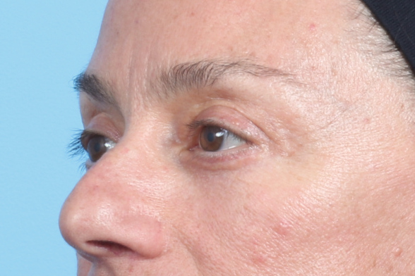 Eyelid Surgery Patient Photo - Case 2544 - after view-1