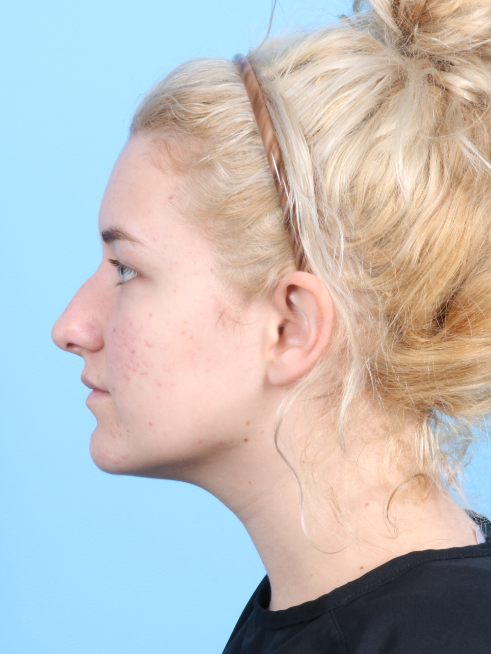 Rhinoplasty Patient Photo - Case 2585 - before view-