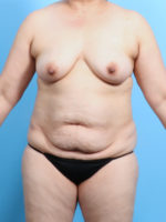 Breast Lift with Implants - Case 2577 - Before