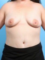 Breast Augmentation - Case 2593 - Before