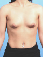 Breast Augmentation - Case 2601 - Before