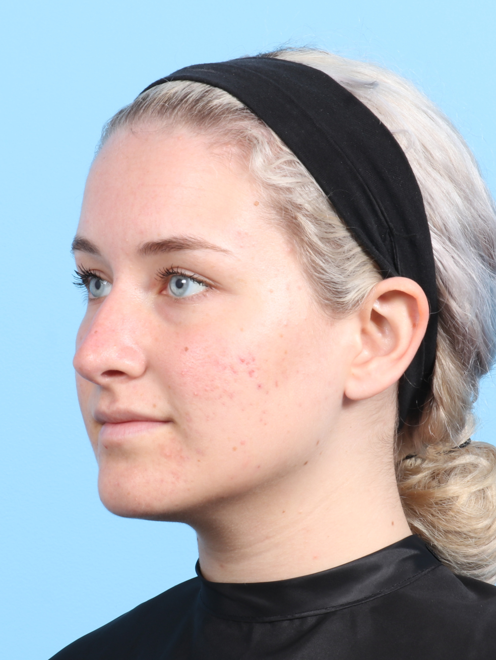 Rhinoplasty Patient Photo - Case 2585 - after view-2