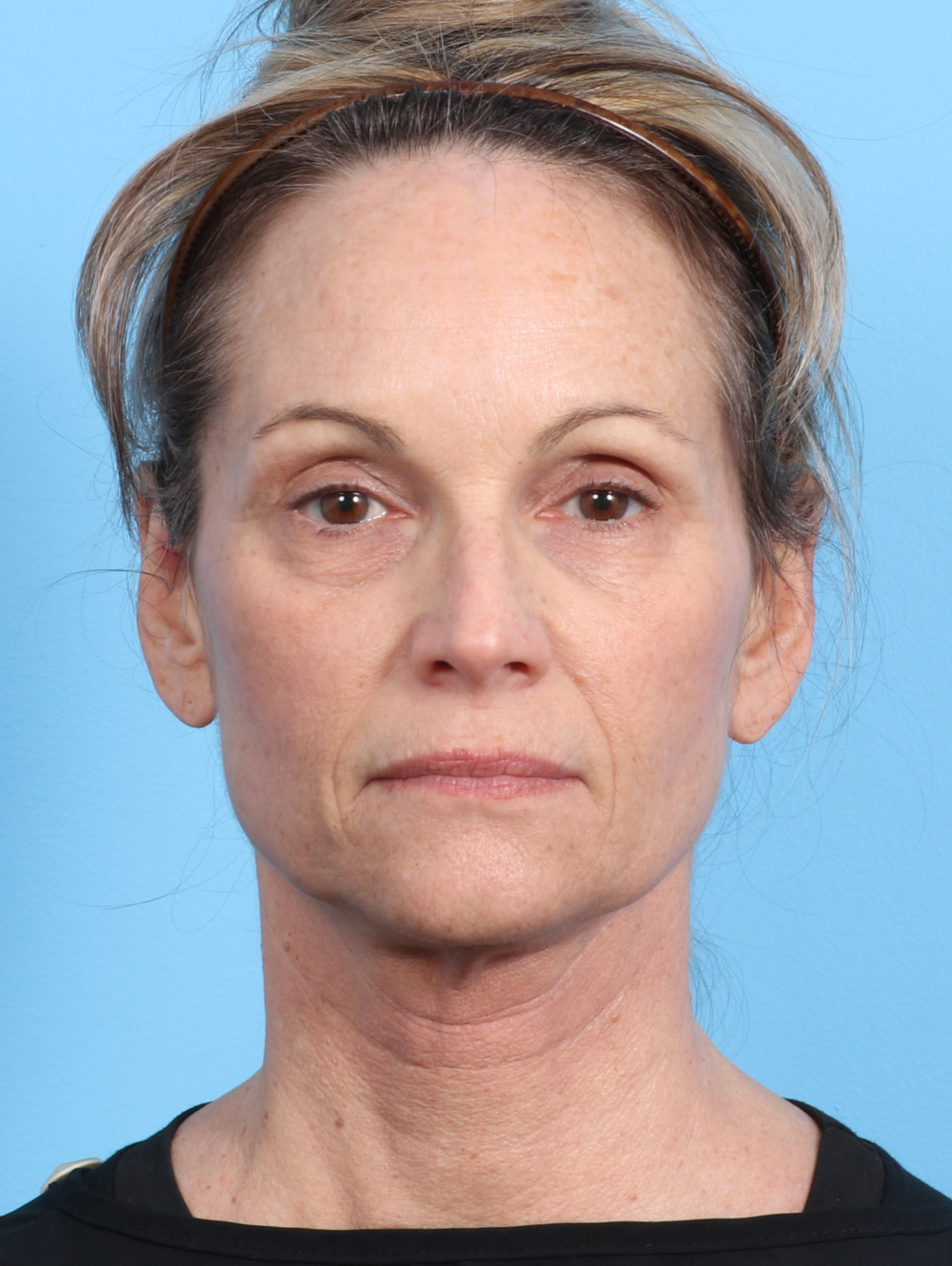 Eyelid Surgery Patient Photo - Case 2647 - before view-