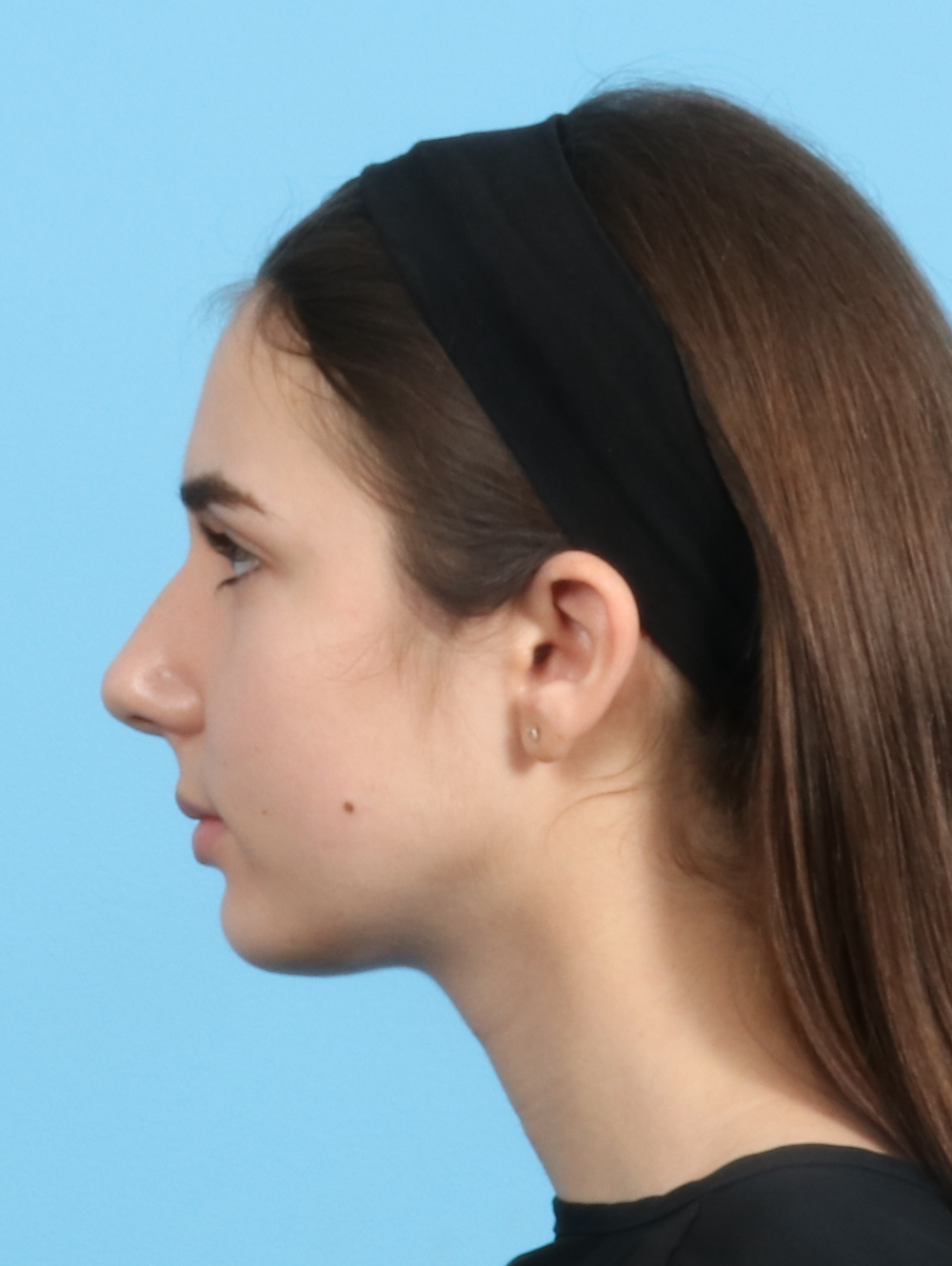 Rhinoplasty Patient Photo - Case 2679 - before view-