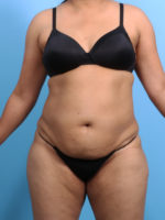 Liposuction - Case 2711 - Before