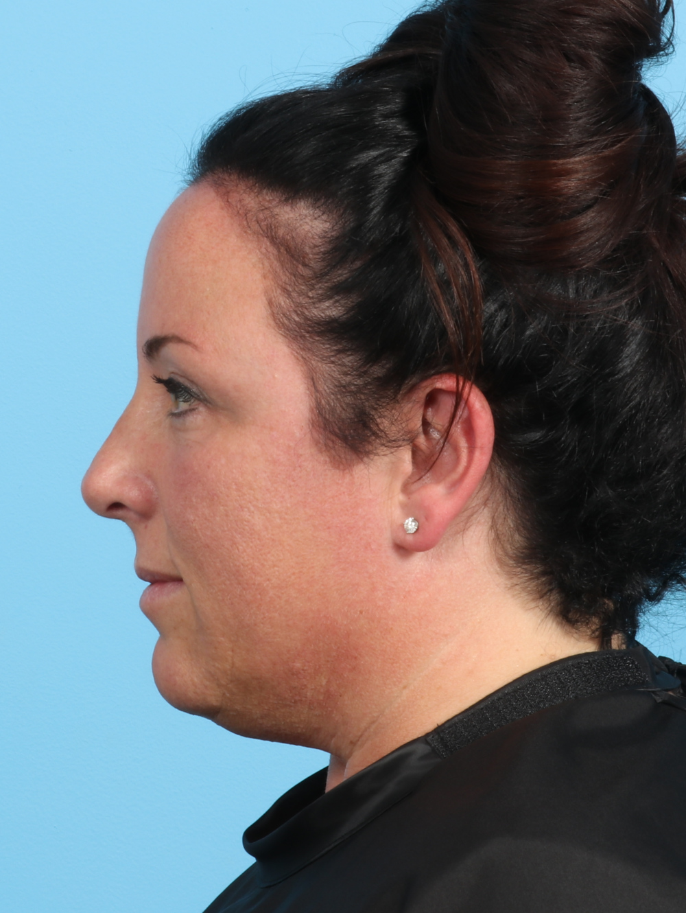 Rhinoplasty Patient Photo - Case 2671 - after view-0