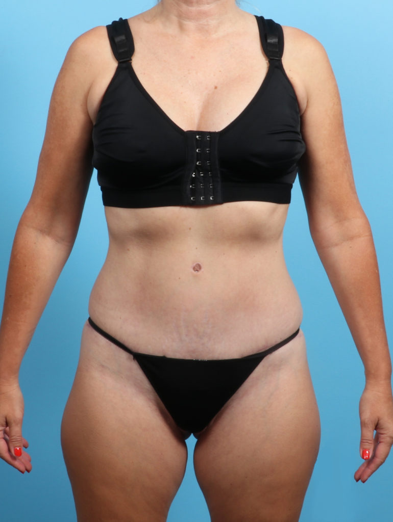 Tummy Tuck - Case 2703 - After
