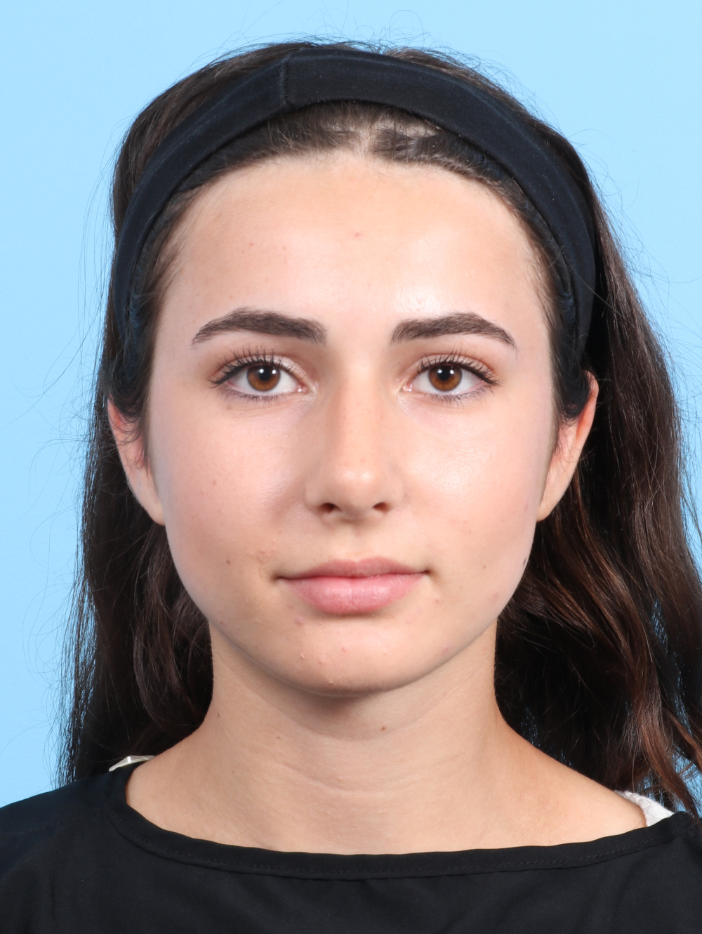 Rhinoplasty Patient Photo - Case 2679 - after view-1