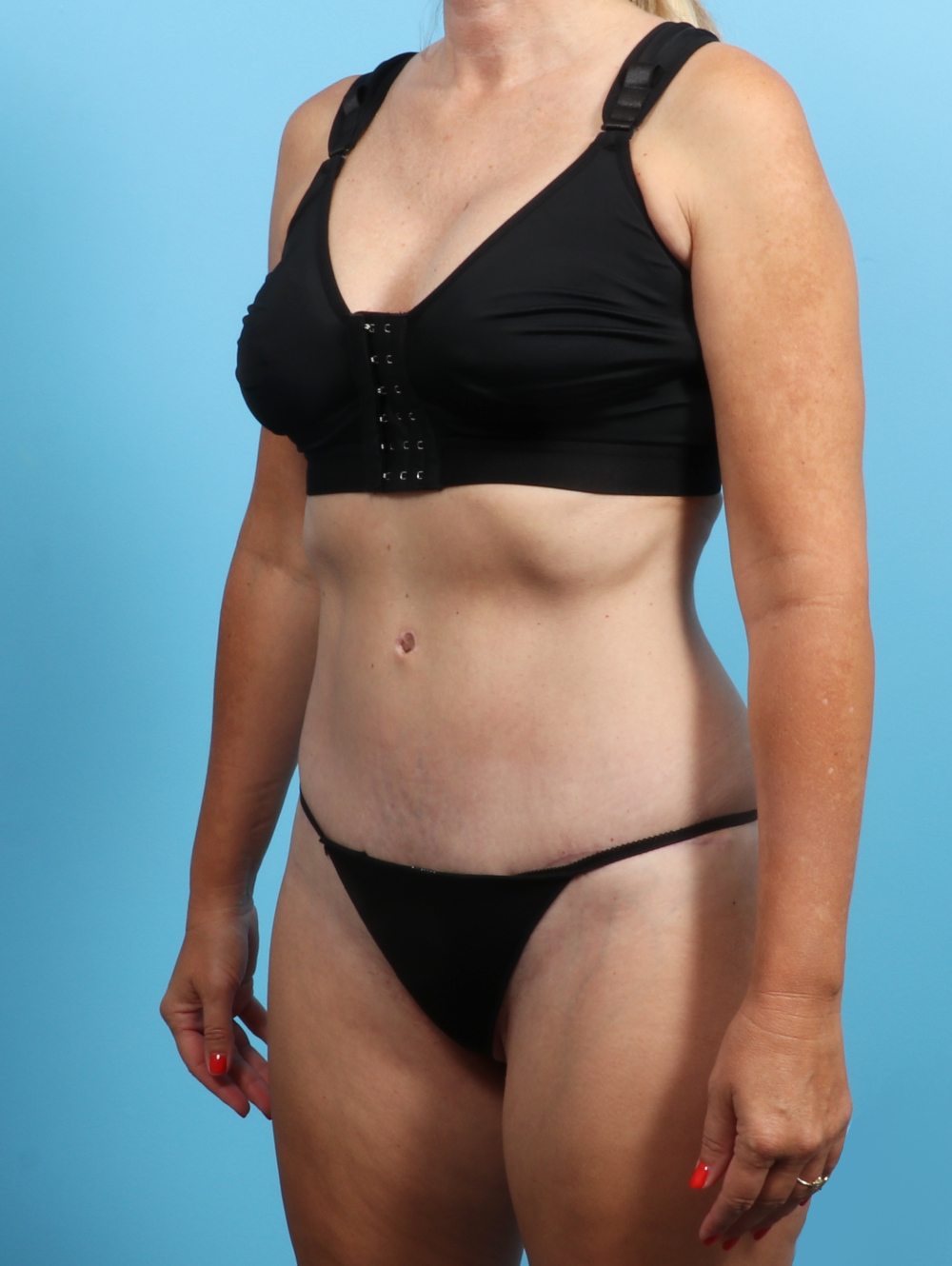 Tummy Tuck Patient Photo - Case 2703 - after view-1