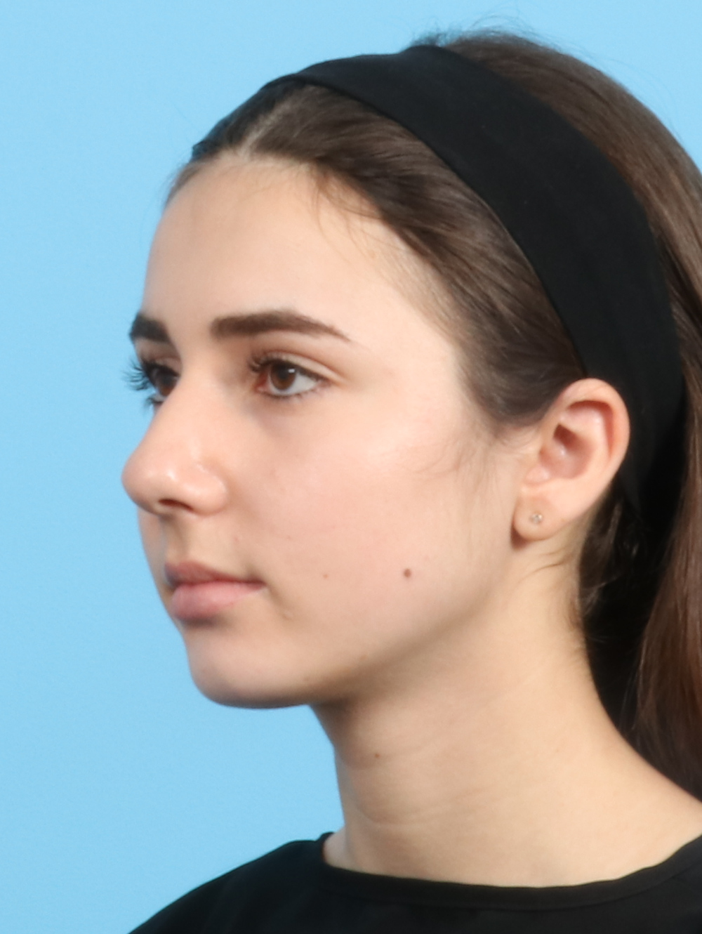 Rhinoplasty Patient Photo - Case 2679 - before view-2