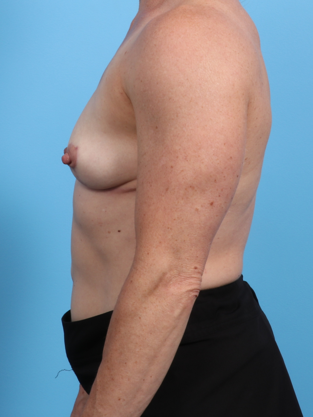 Breast Implant Revision Patient Photo - Case 2763 - after view-2