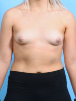 Breast Augmentation - Case 2817 - Before