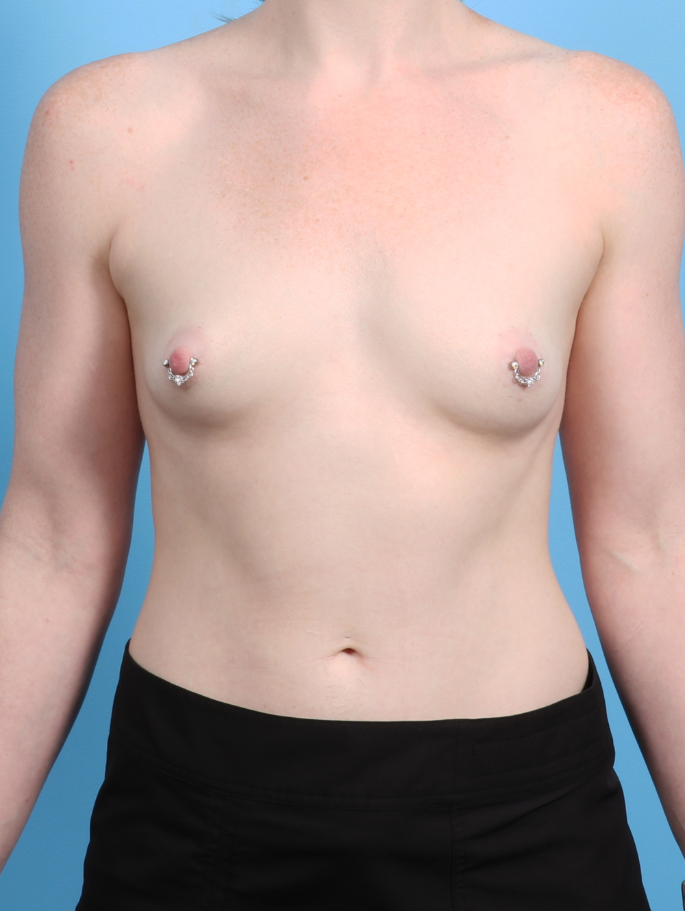 Breast Augmentation Patient Photo - Case 2897 - before view-