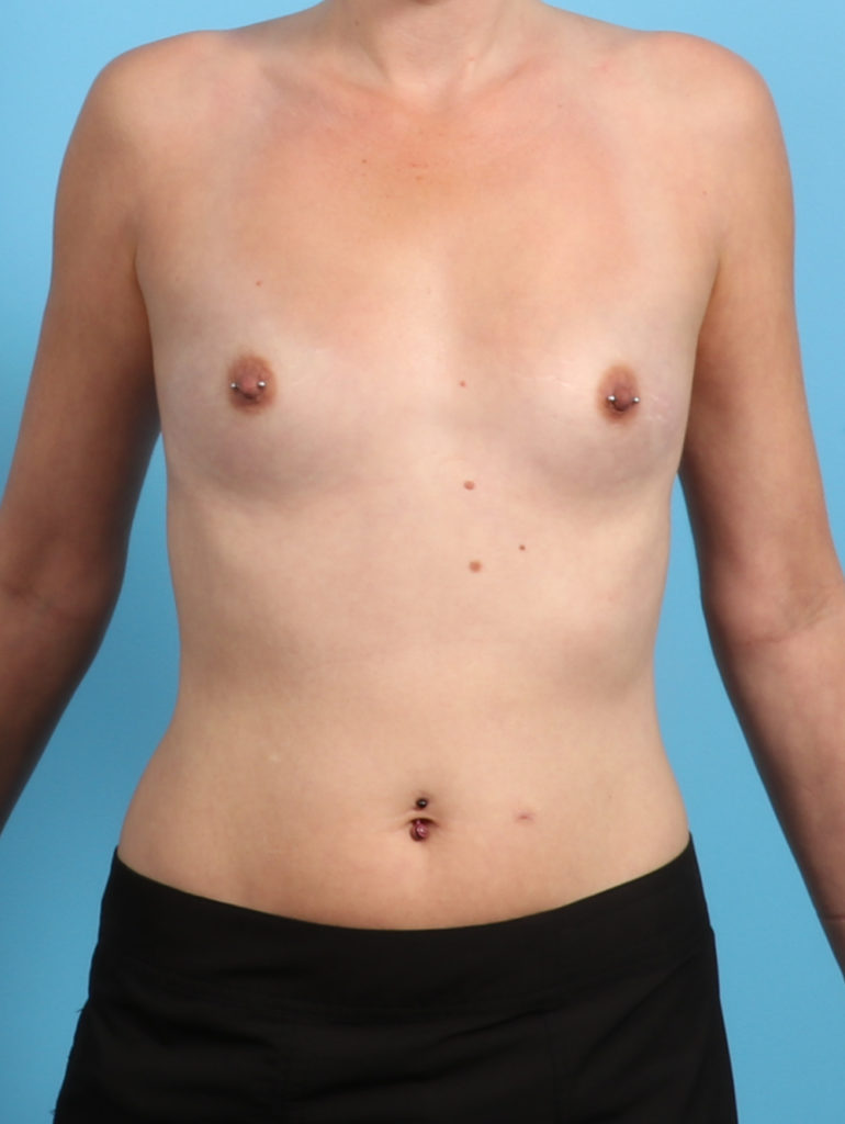 Breast Augmentation - Case 2905 - Before