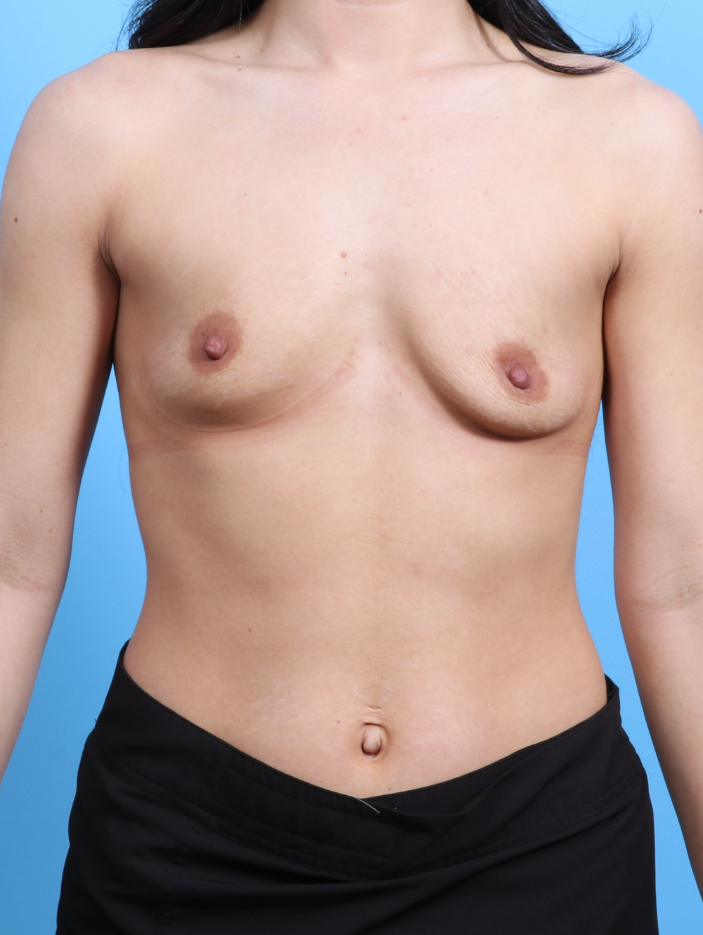 Breast Augmentation Patient Photo - Case 2913 - before view-0