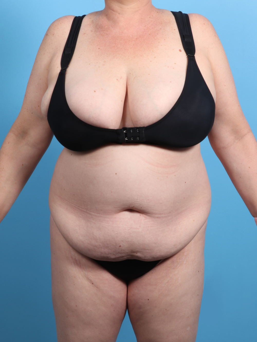 Tummy Tuck Patient Photo - Case 2825 - before view-0