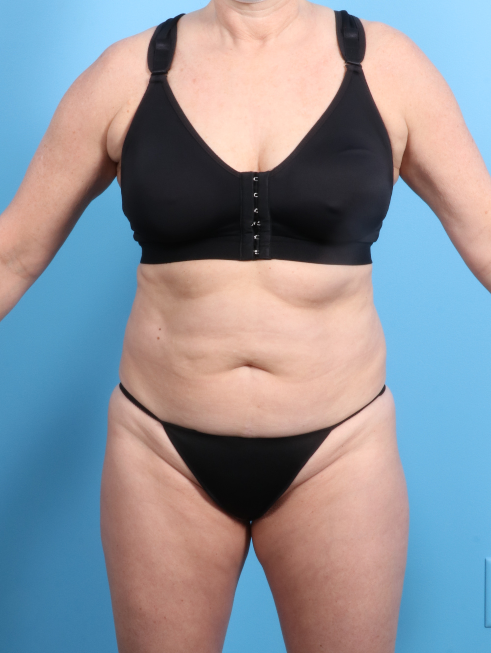 Tummy Tuck Patient Photo - Case 2833 - before view-0