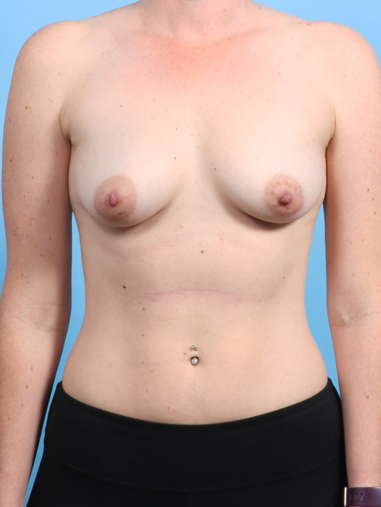 Breast Augmentation - Case 2865 - Before