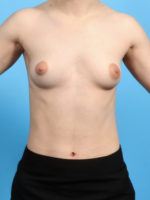 Breast Augmentation - Case 2873 - Before