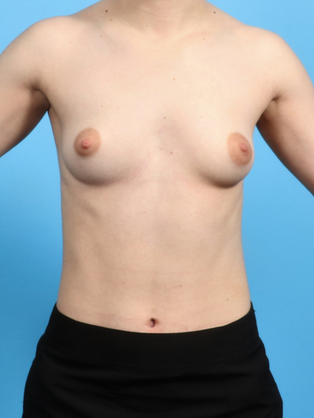 Breast Augmentation Patient Photo - Case 2873 - before view-