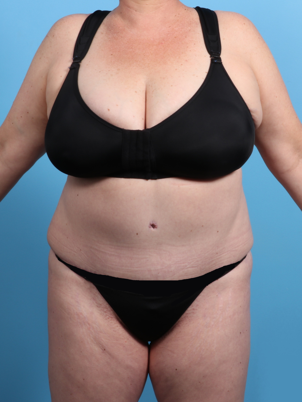 Tummy Tuck Patient Photo - Case 2825 - after view