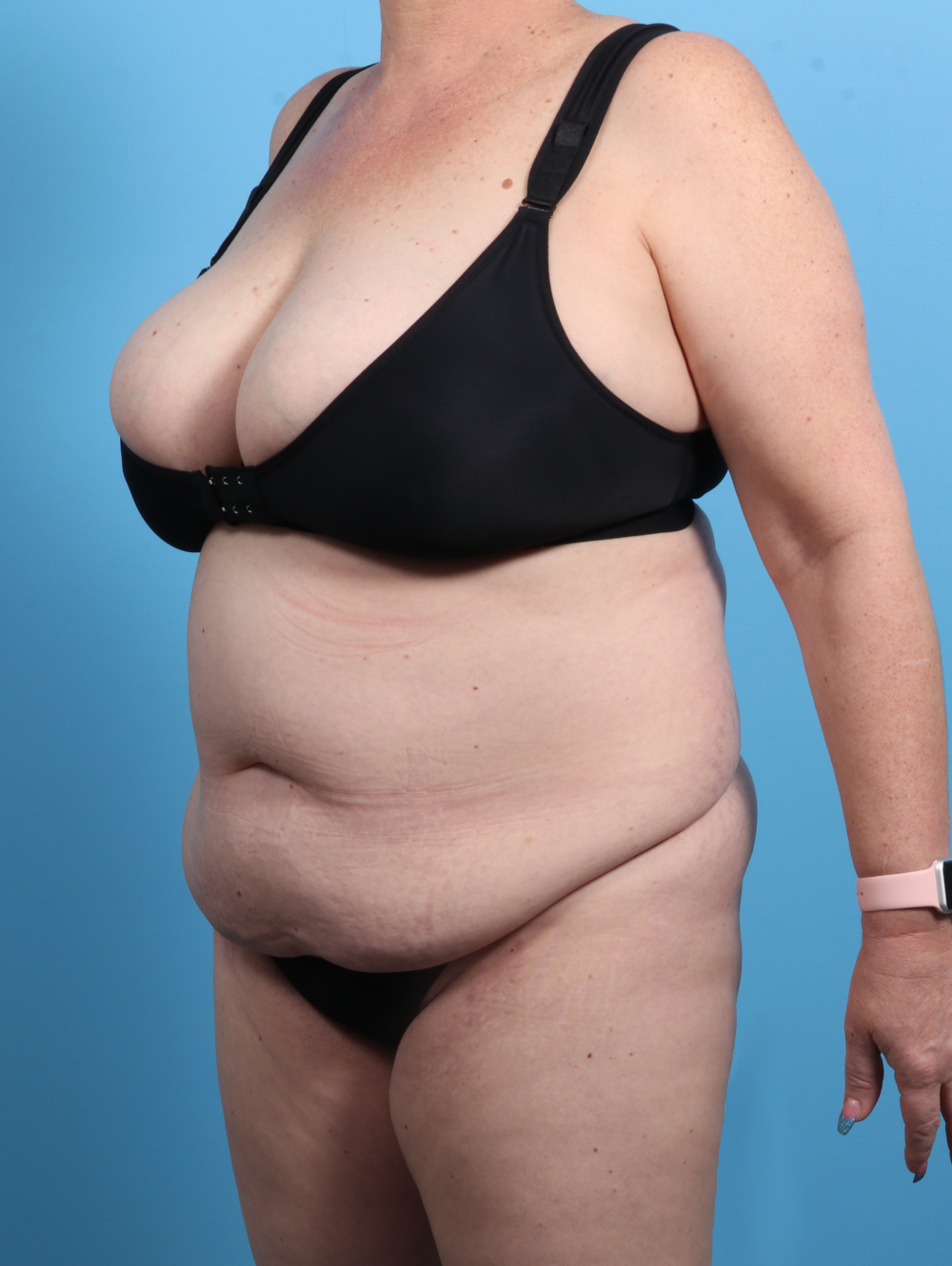 Tummy Tuck Patient Photo - Case 2825 - before view-1