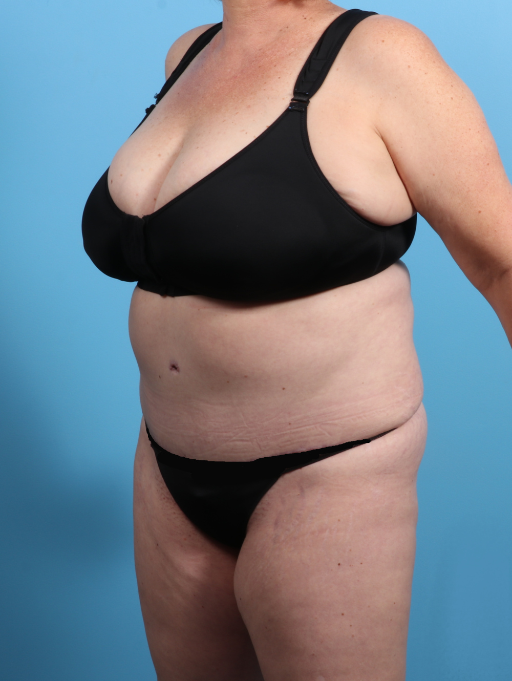 Tummy Tuck Patient Photo - Case 2825 - after view-1