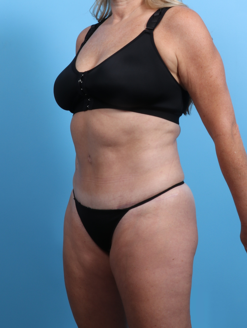 Tummy Tuck Patient Photo - Case 2833 - after view-1