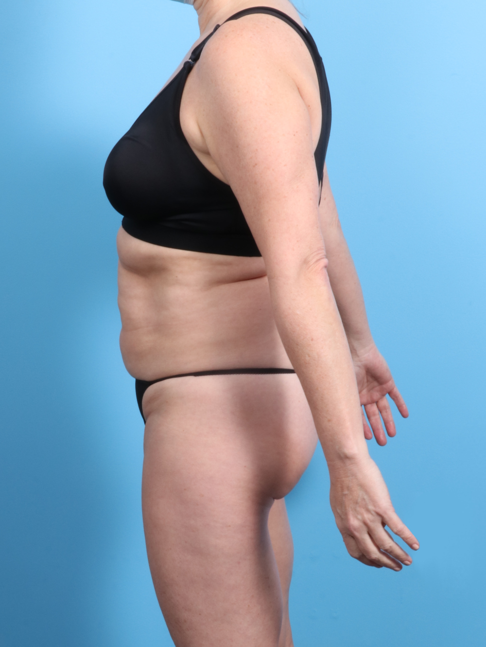 Tummy Tuck Patient Photo - Case 2833 - before view-2