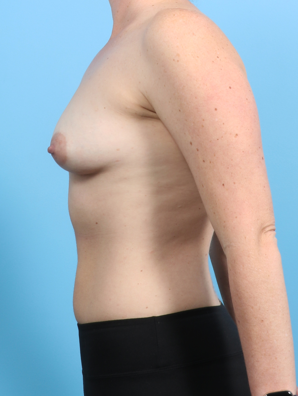 Breast Augmentation Patient Photo - Case 2865 - before view-2