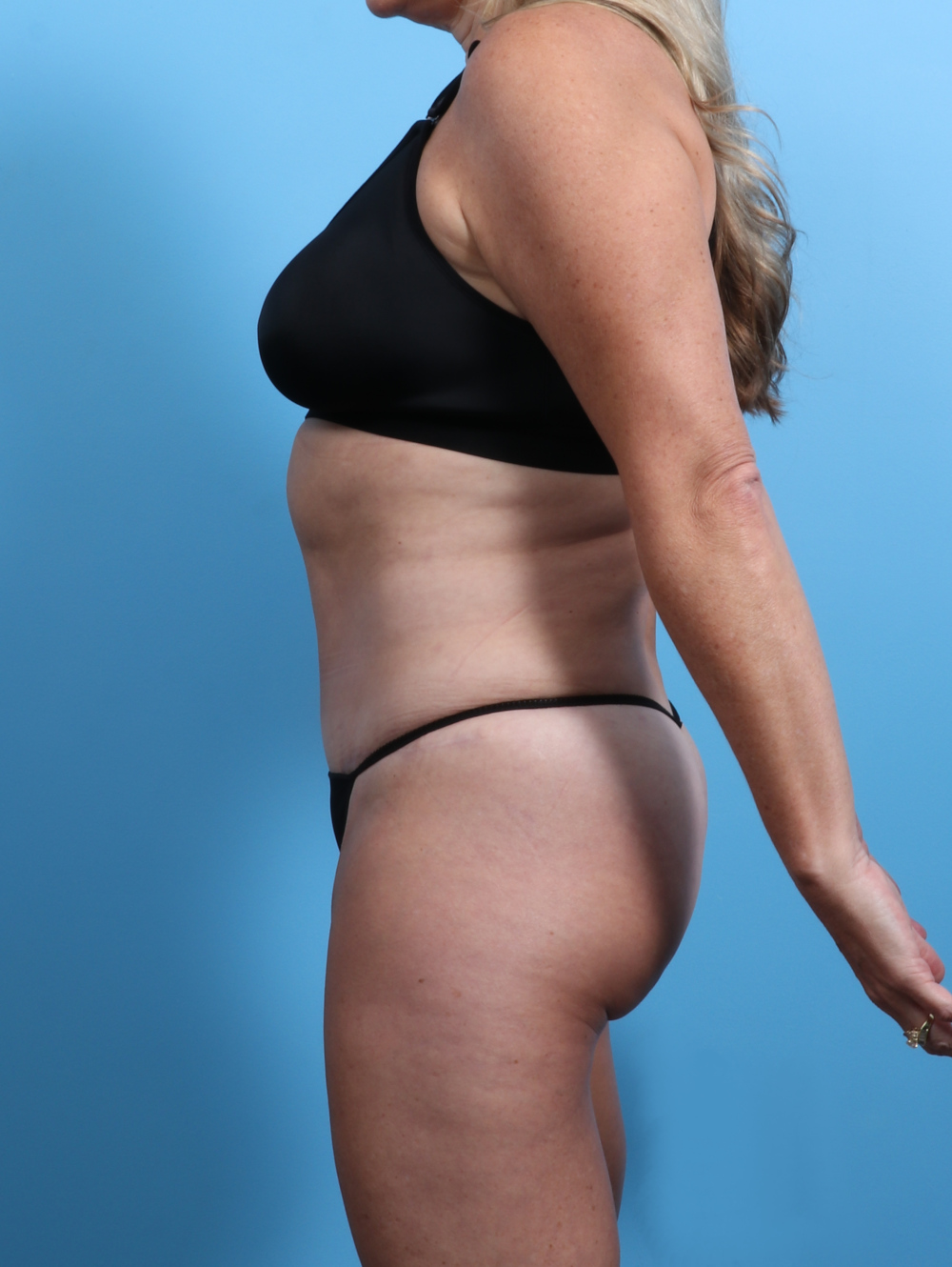 Tummy Tuck Patient Photo - Case 2833 - after view-2