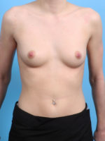 Breast Augmentation - Case 2947 - Before