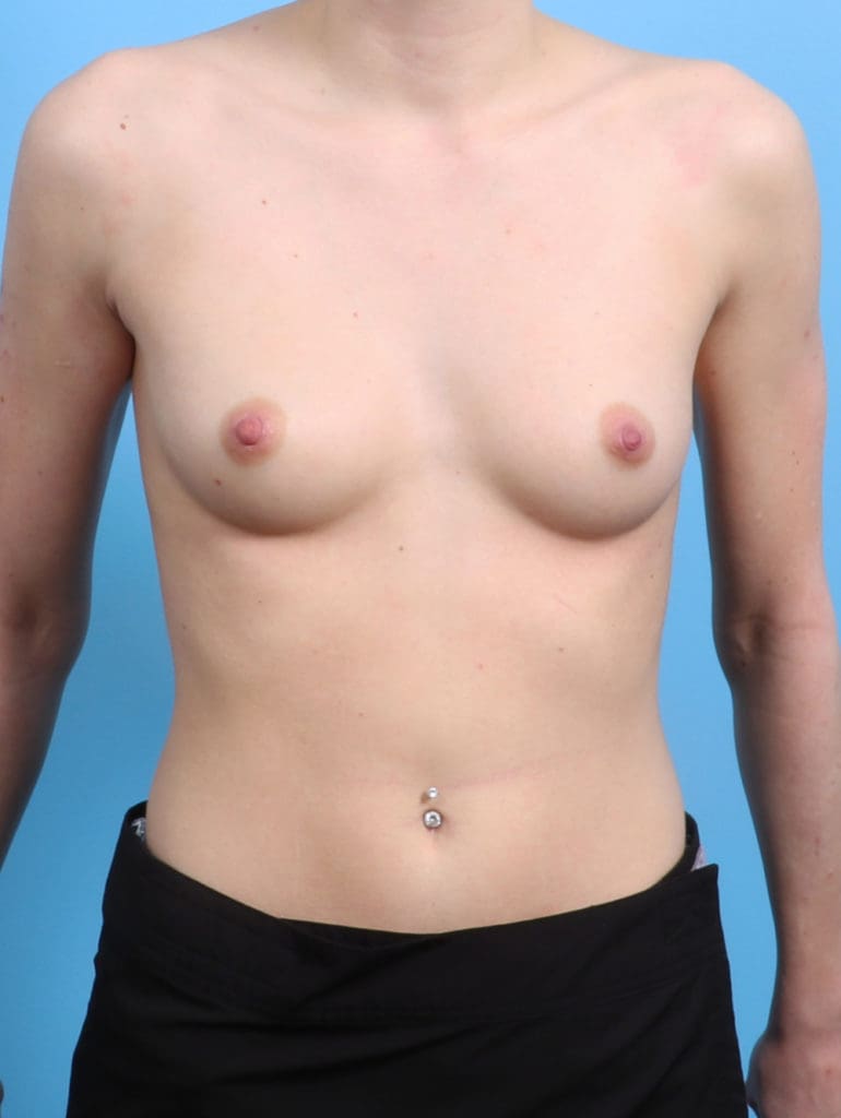 Breast Augmentation - Case 2947 - Before