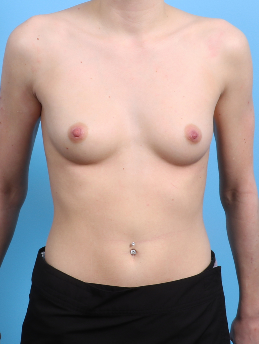 Breast Augmentation Patient Photo - Case 2947 - before view-