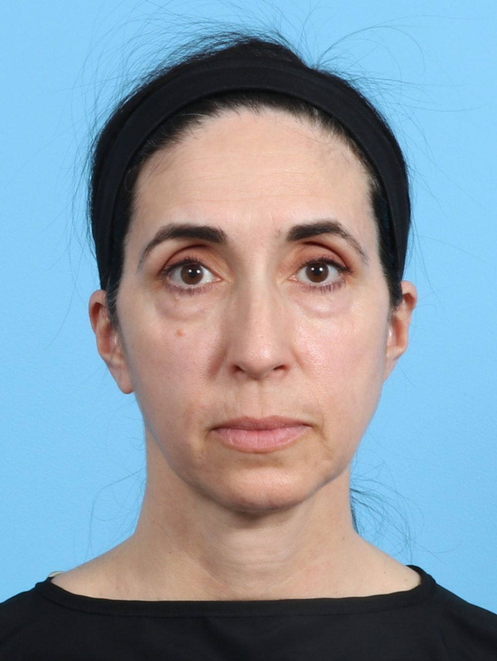 Eyelid Surgery Patient Photo - Case 2963 - before view-