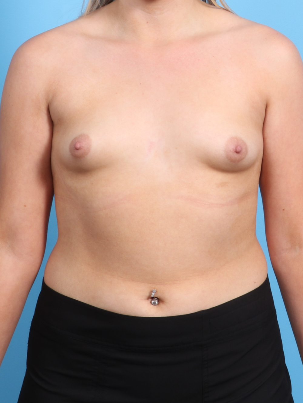 Breast Augmentation Patient Photo - Case 2931 - before view-0