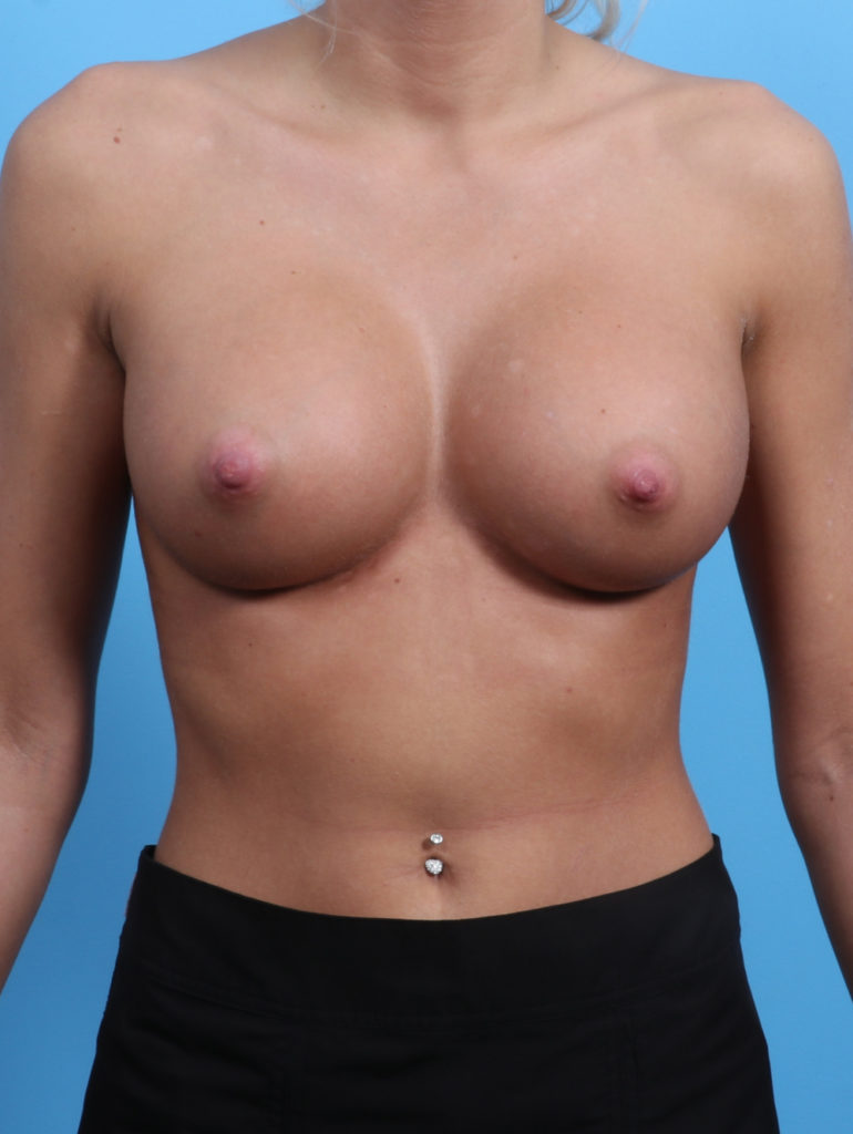 Breast Augmentation - Case 2947 - After