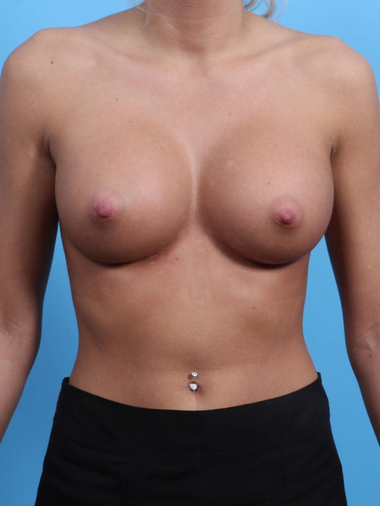 Breast Augmentation - Case 2947 - After