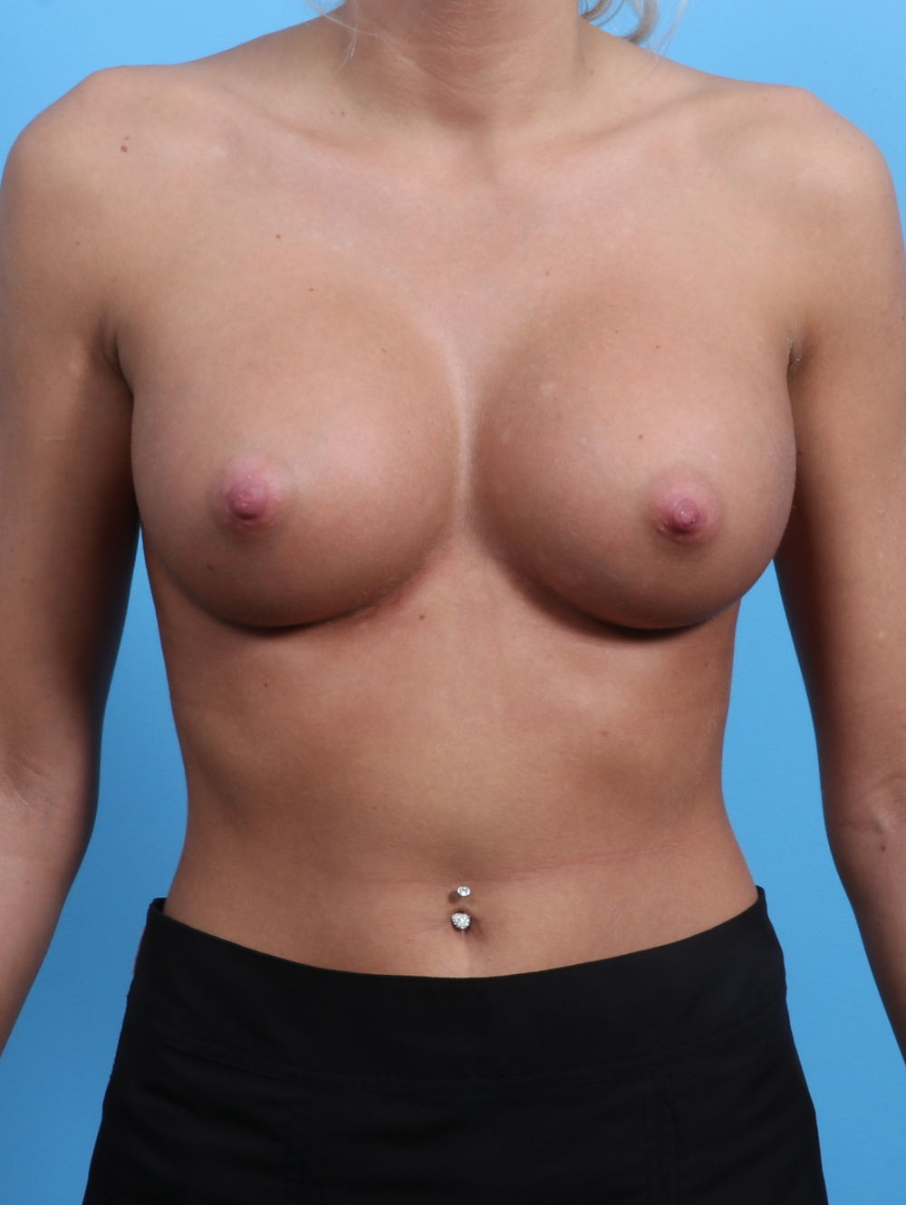 Breast Augmentation Patient Photo - Case 2947 - after view