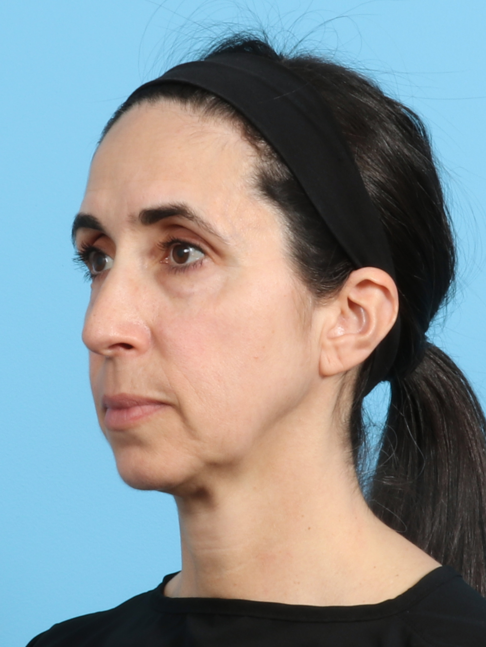 Eyelid Surgery Patient Photo - Case 2963 - before view-1