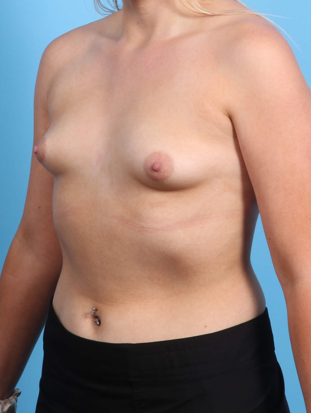 Breast Augmentation Patient Photo - Case 2931 - before view-1