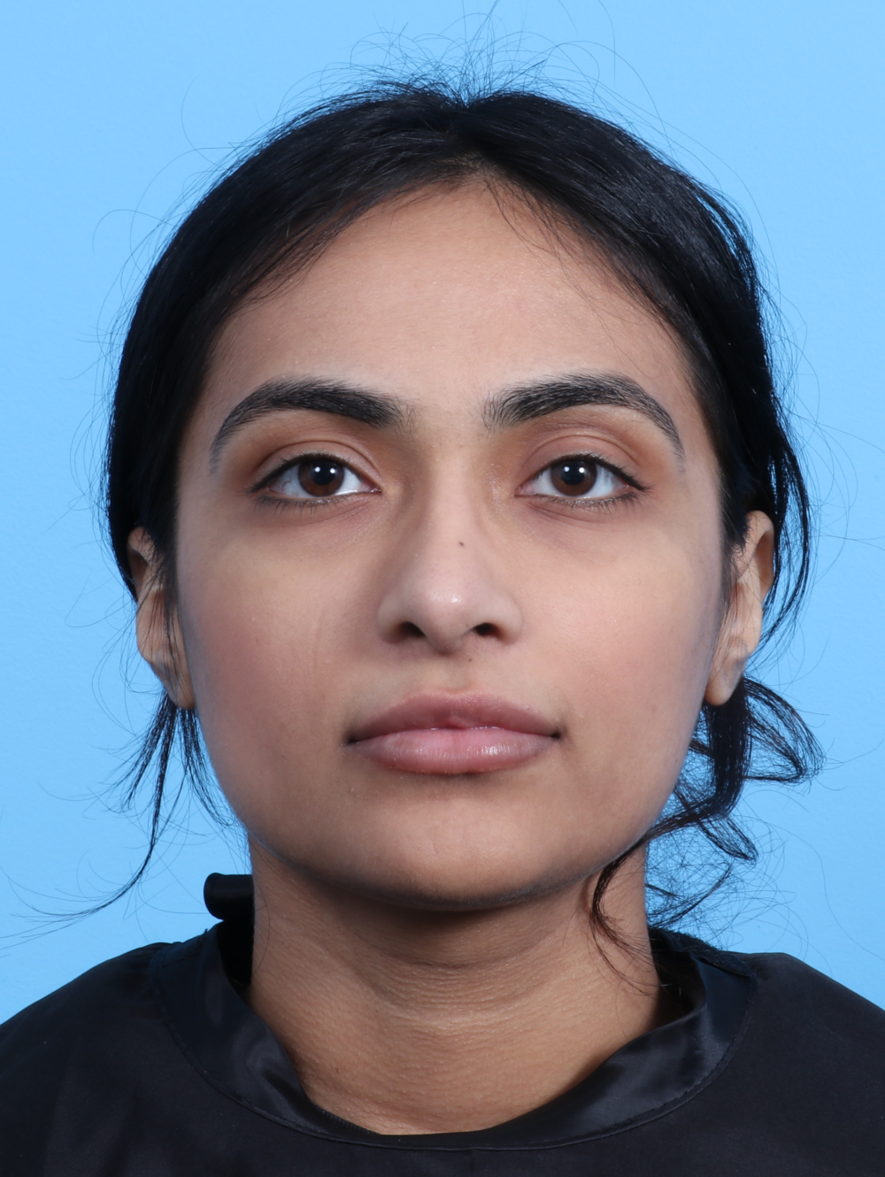 Rhinoplasty Patient Photo - Case 2979 - after view-1